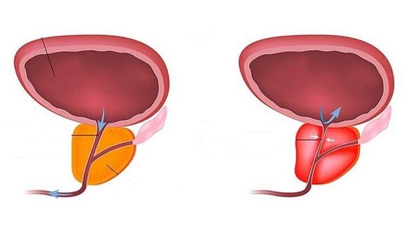 Healthy and inflamed prostate with prostatitis